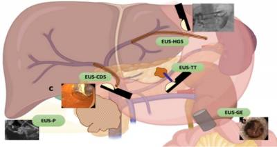 Η χρήση του ενδοσκοπικού υπερηχογραφήματος στην διαχείριση του πόνου στον παγκρεατικό καρκίνο