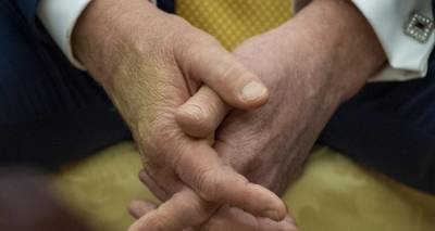 Ο Τραμπ διαγνώστηκε με χρόνια φλεβική ανεπάρκεια -Τι σημαίνει, συμπτώματα, αιτίες και θεραπεία