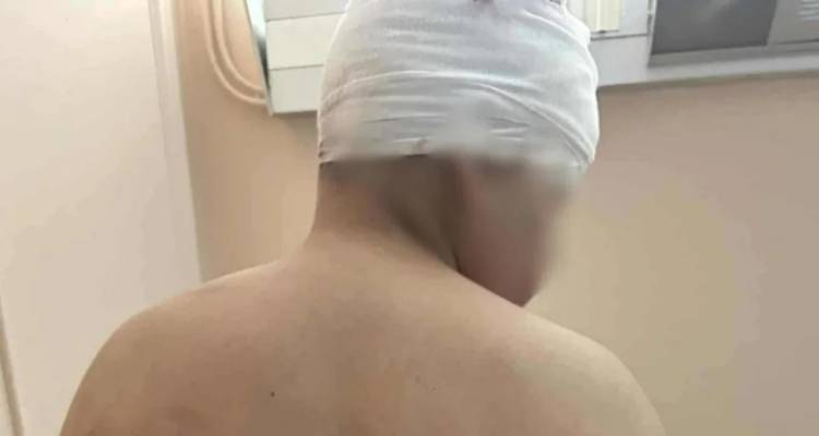 Θεσσαλονίκη: Σοκάρει ο πατέρας του 13χρονου που ξυλοκοπήθηκε | «Τον χτυπούσαν με σίδερα, λείπει κομμάτι από το κεφάλι του»