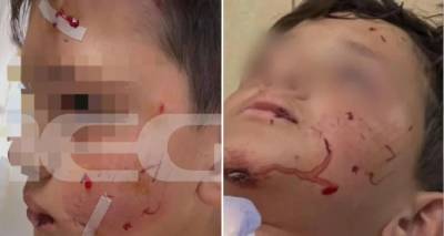 &Lambda;&alpha;&gamma;&omicron;&nu;ή&sigma;&iota;: &Sigma;&kappa;ύ&lambda;&omicron;&sigmaf; &epsilon;&pi;&iota;&tau;έ&theta;&eta;&kappa;&epsilon; ά&gamma;&rho;&iota;&alpha; &sigma;&epsilon; 13&chi;&rho;&omicron;&nu;&omicron; &tau;&eta;&nu; ώ&rho;&alpha; &pi;&omicron;&upsilon; &pi;ή&gamma;&alpha;&iota;&nu;&epsilon; &sigma;&chi;&omicron;&lambda;&epsilon;ί&omicron; | &Mu;&epsilon; &beta;&alpha;&theta;&iota;ά &tau;&rho;&alpha;ύ&mu;&alpha;&tau;&alpha; &sigma;&tau;&omicron; &pi;&rho;ό&sigma;&omega;&pi;&omicron; &tau;&omicron; &pi;&alpha;&iota;&delta;ί