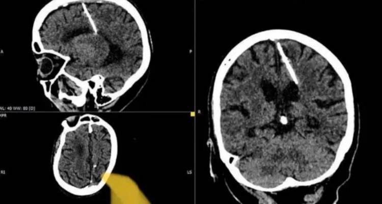 80χρονη ζει με βελόνα στον εγκέφαλο από μωρό | «Οι γονείς της προσπάθησαν να τη σκοτώσουν όταν ήταν ημερών»