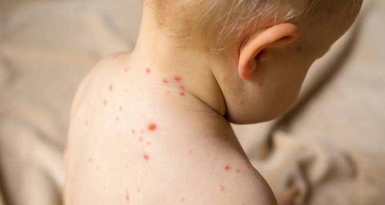 Συναγερμός για την ιλαρά στην Ευρώπη: Τεράστια αύξηση κρουσμάτων, από 941 το 2022, πάνω από 30.000 το 2023