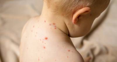 Συναγερμός για την ιλαρά στην Ευρώπη: Τεράστια αύξηση κρουσμάτων, από 941 το 2022, πάνω από 30.000 το 2023