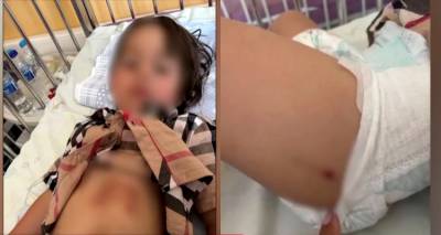 Χαλκιδική: Σοκάρουν τα τραύματα του 5χρονου κοριτσιού που δέχθηκε επίθεση από λύκο