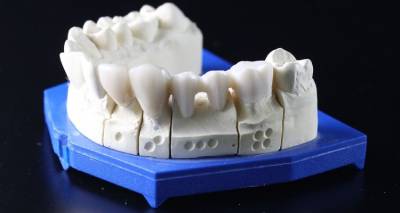 Εμφυτεύματα δοντιών: Oι παρενέργειές τους &amp; πώς να τις αποφύγετε;