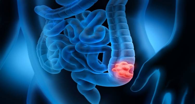 Καρκίνος παχέος εντέρου: Δωρεάν self test για 2,8 εκατομμύρια άνδρες και γυναίκες -Υπεγράφη η ΚΥΑ